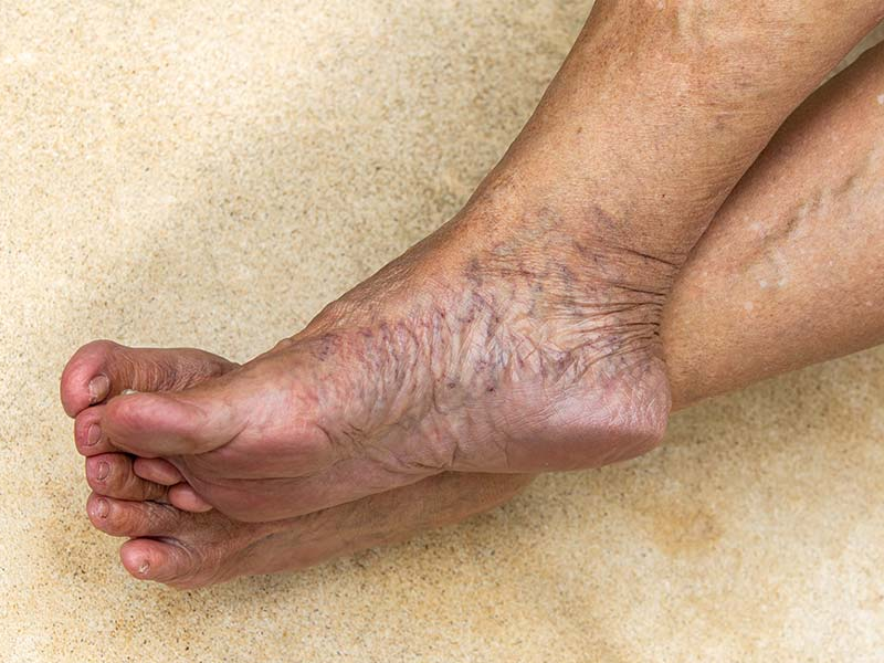 Varicose Veins