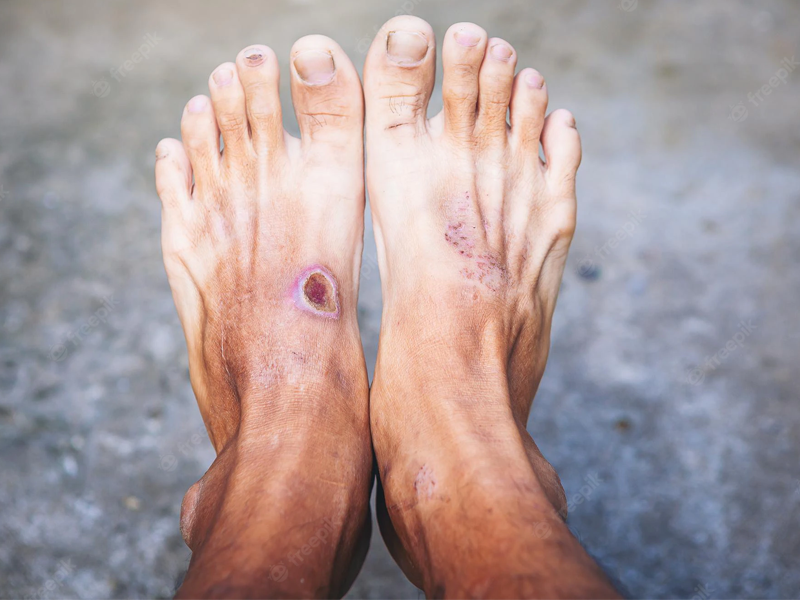 diabetic foot